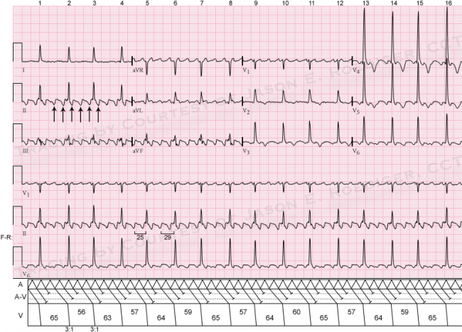 Atrial flutter with 3:1 A-V conduction | ECG Guru - Instructor Resources