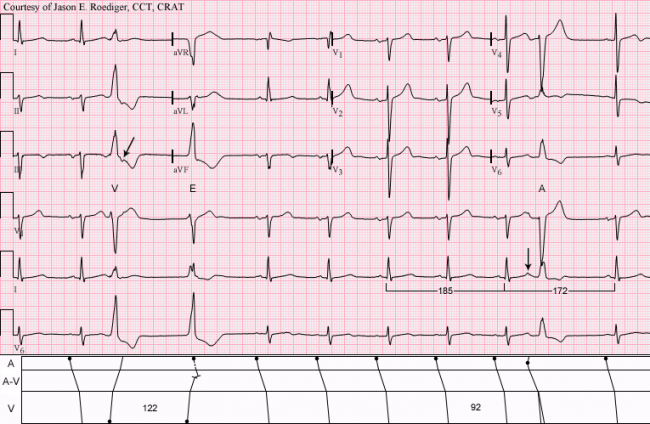rbbb ecg