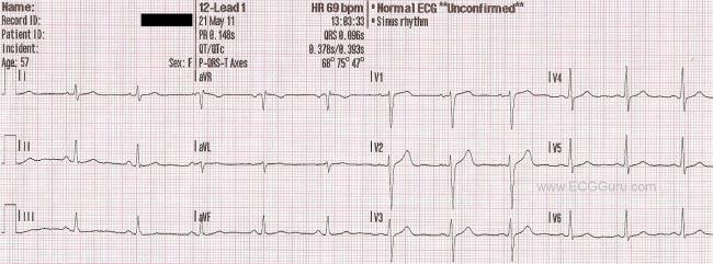 What is an example of normal sinus rhythm?