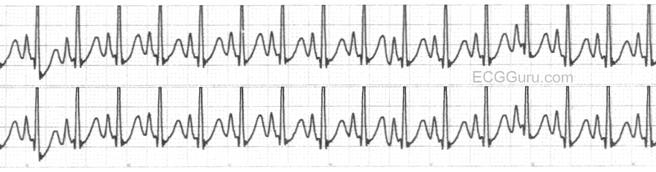 Ecg Basics Sinus Tachycardia In A Toddler Ecg Guru Instructor Resources