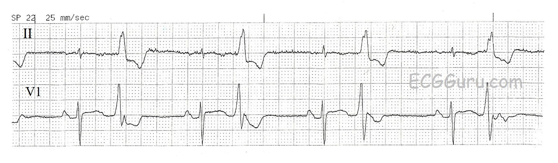 Ecg Basics Sinus Rhythm With Ventricular Bigeminy Ecg Guru Instructor Resources