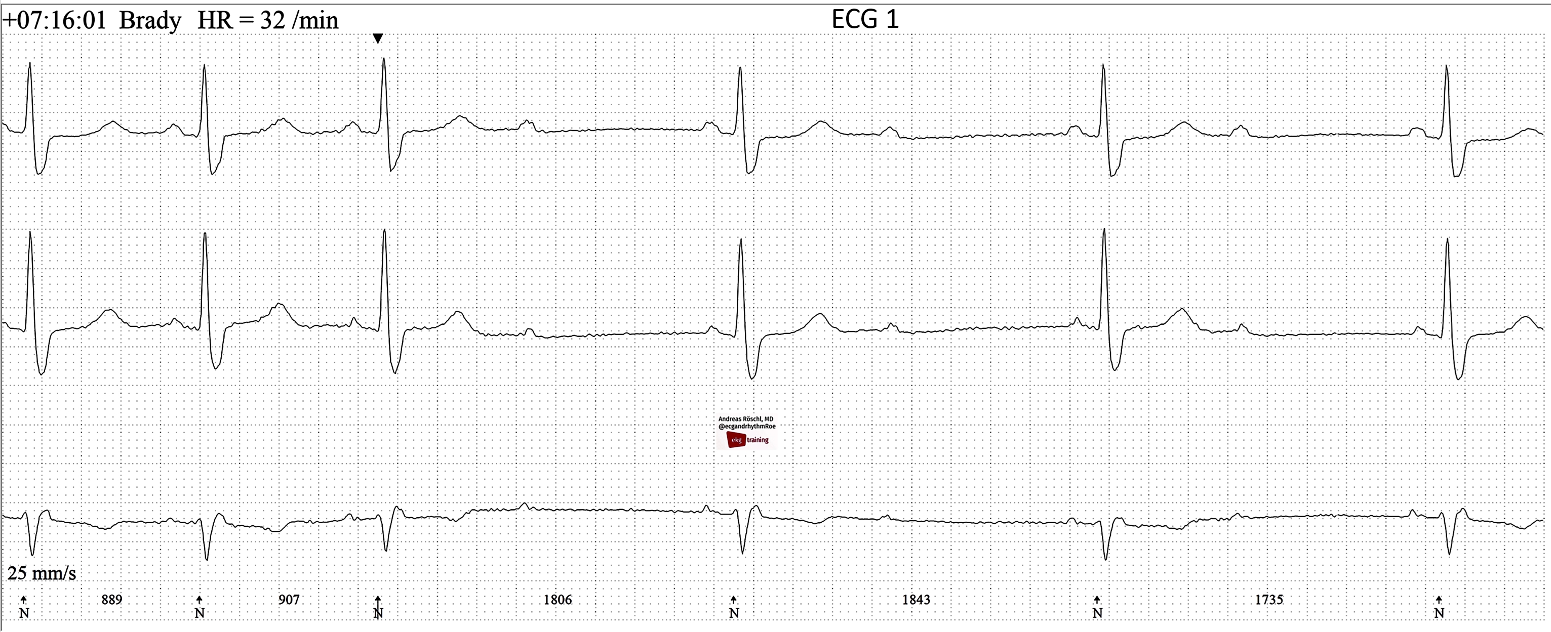 2:1 AV block  ECG Guru - Instructor Resources