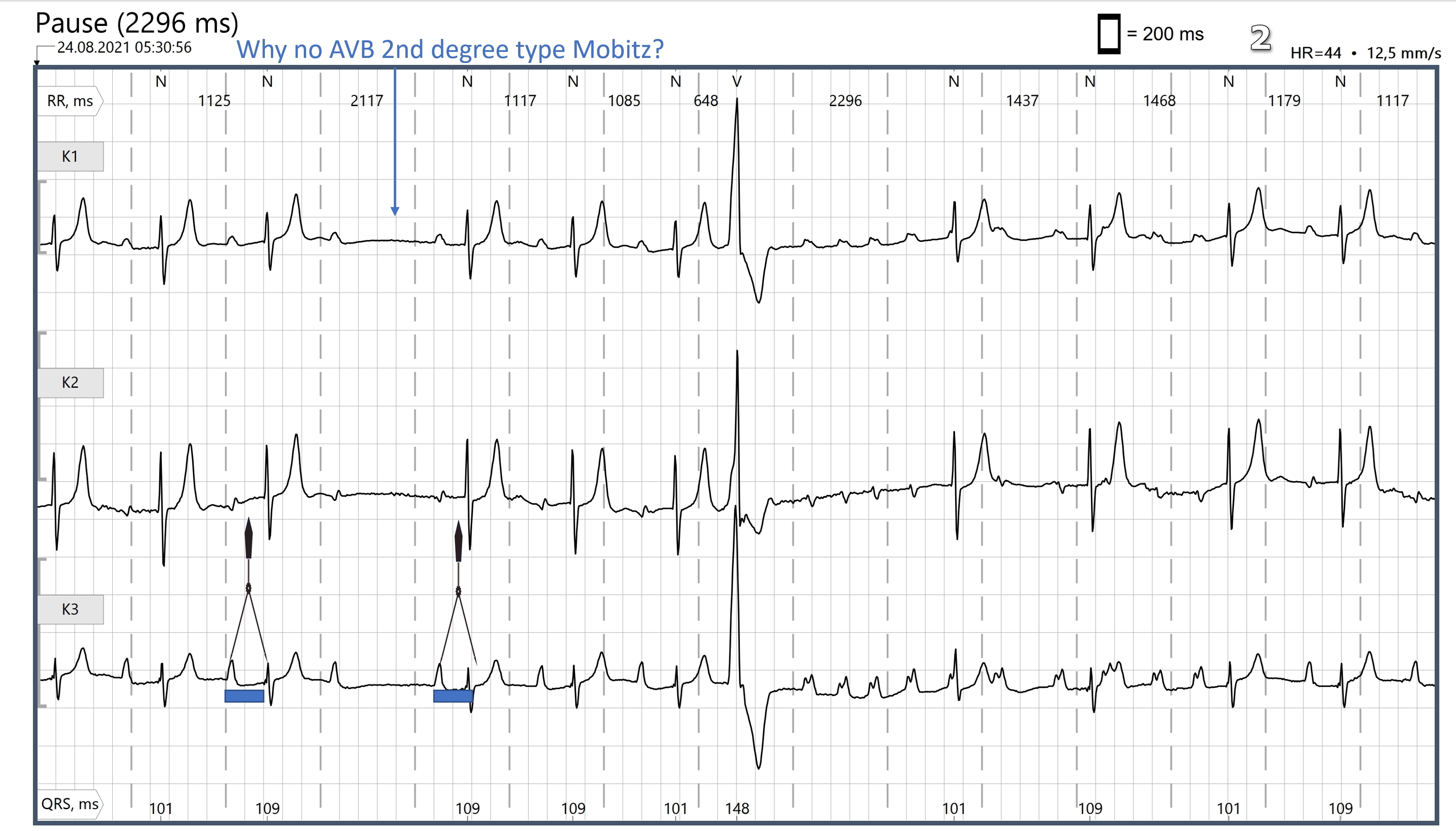 Unusual presentation of STEMI : Mobitz type 2 AV block