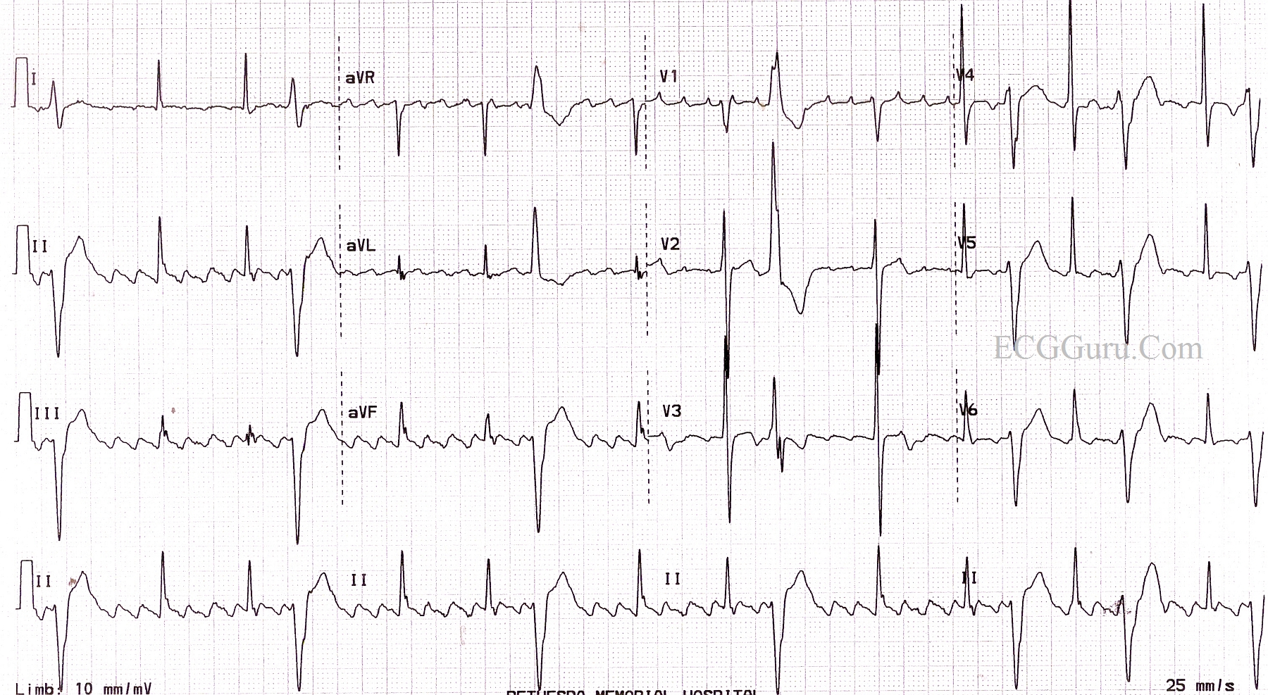 Typical atrial flutter and ecg - mumuholo