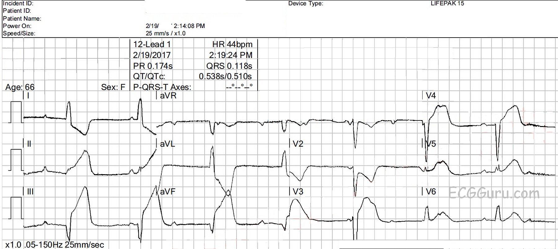 AV block: 3rd degree (complete heart block) • LITFL • ECG Library