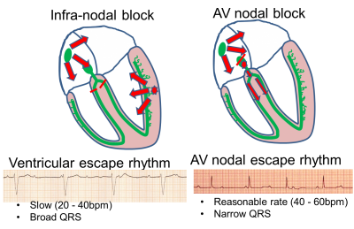 junctional escape rhythm diagram