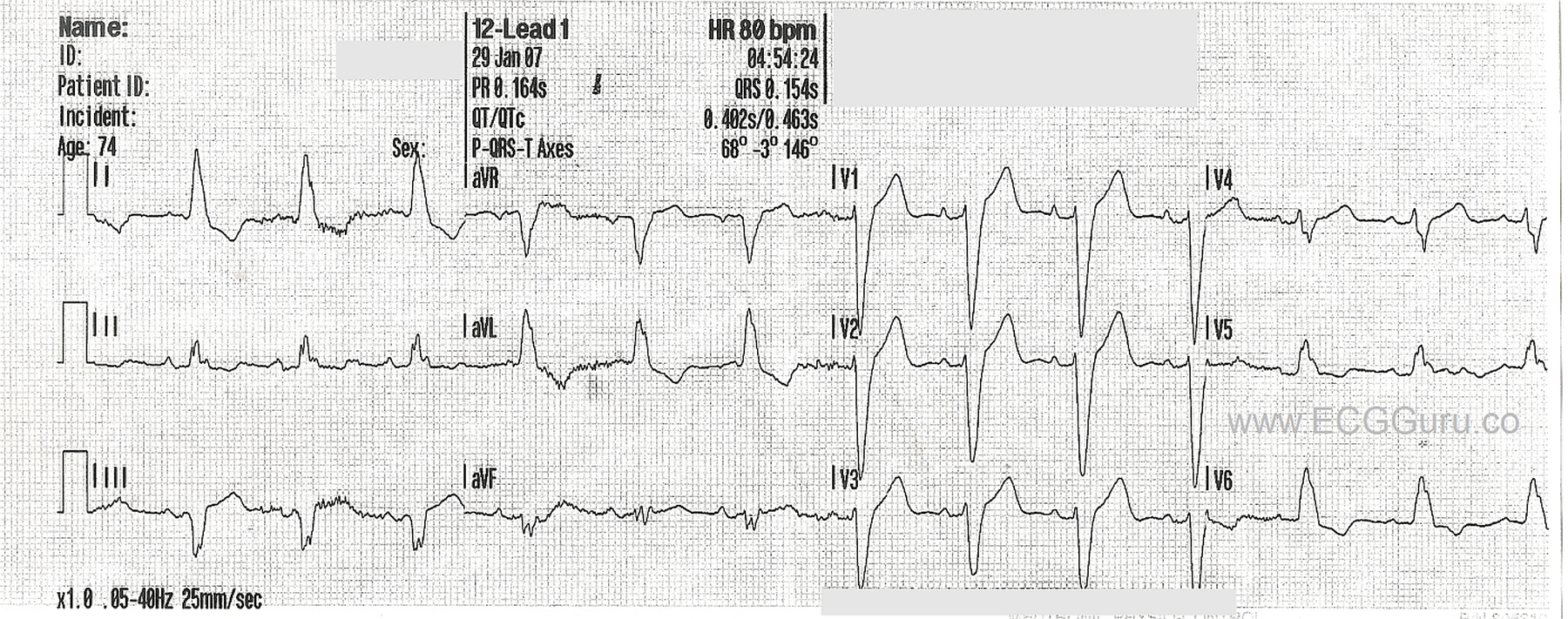 Left Bundle Branch Block Anatomy