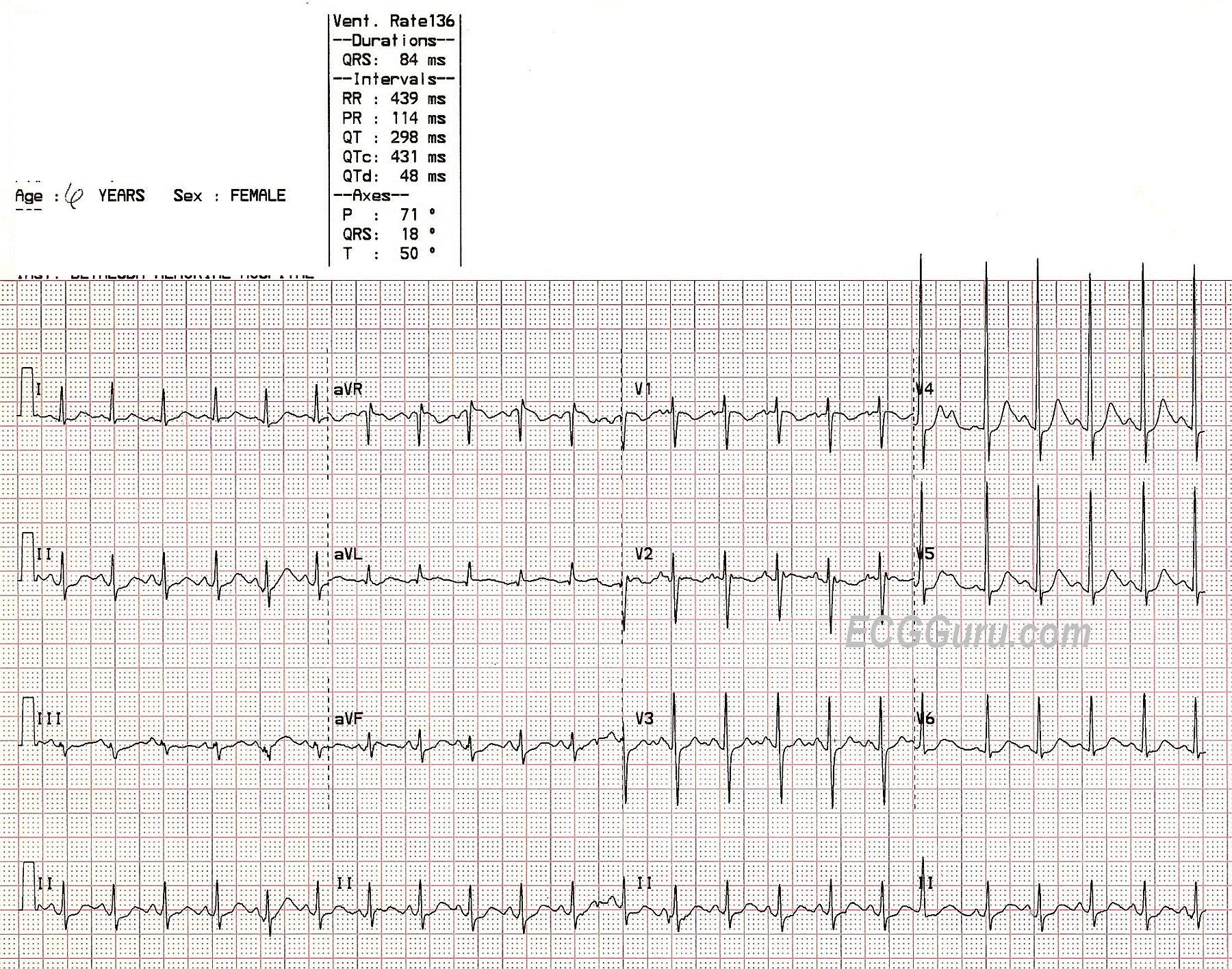 Sinus Tachycardia In A Child Ecg Guru Instructor Resources