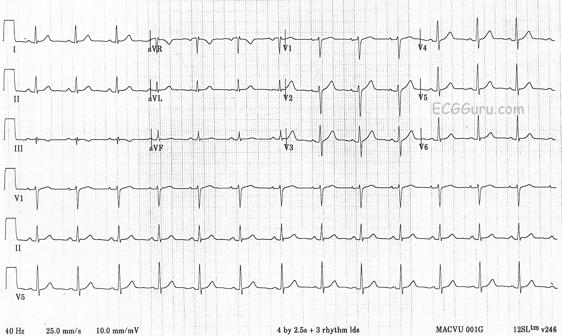 12 Lead Ecg Depicting Reversal Of V1 And V6 A Ecg Recording B All In