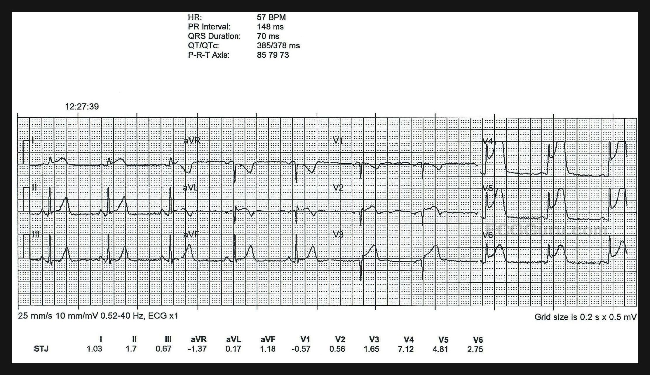 The ST Segment • LITFL • ECG Library Basics