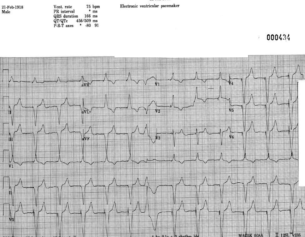 Pseudo Malplacement of Pacemaker Wire