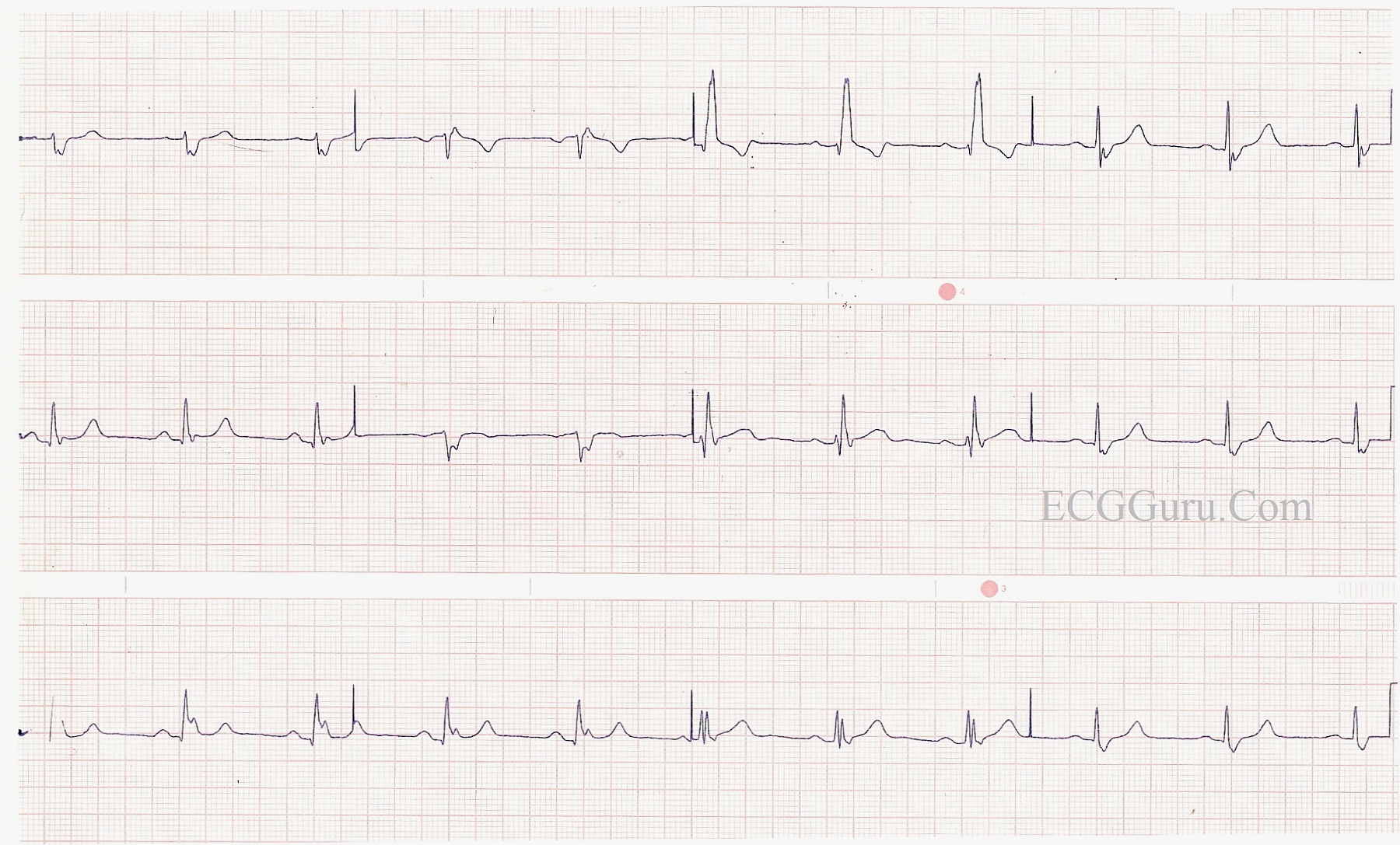 Right Bundle Branch Block With Left Posterior Fascicular Block Ecg Guru Instructor Resources