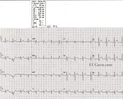 NSR After Conversion From Atrial Flutter With 1:1 Conduction and RBBB NSR after conversion from atrial flutter with 1:1 conduction