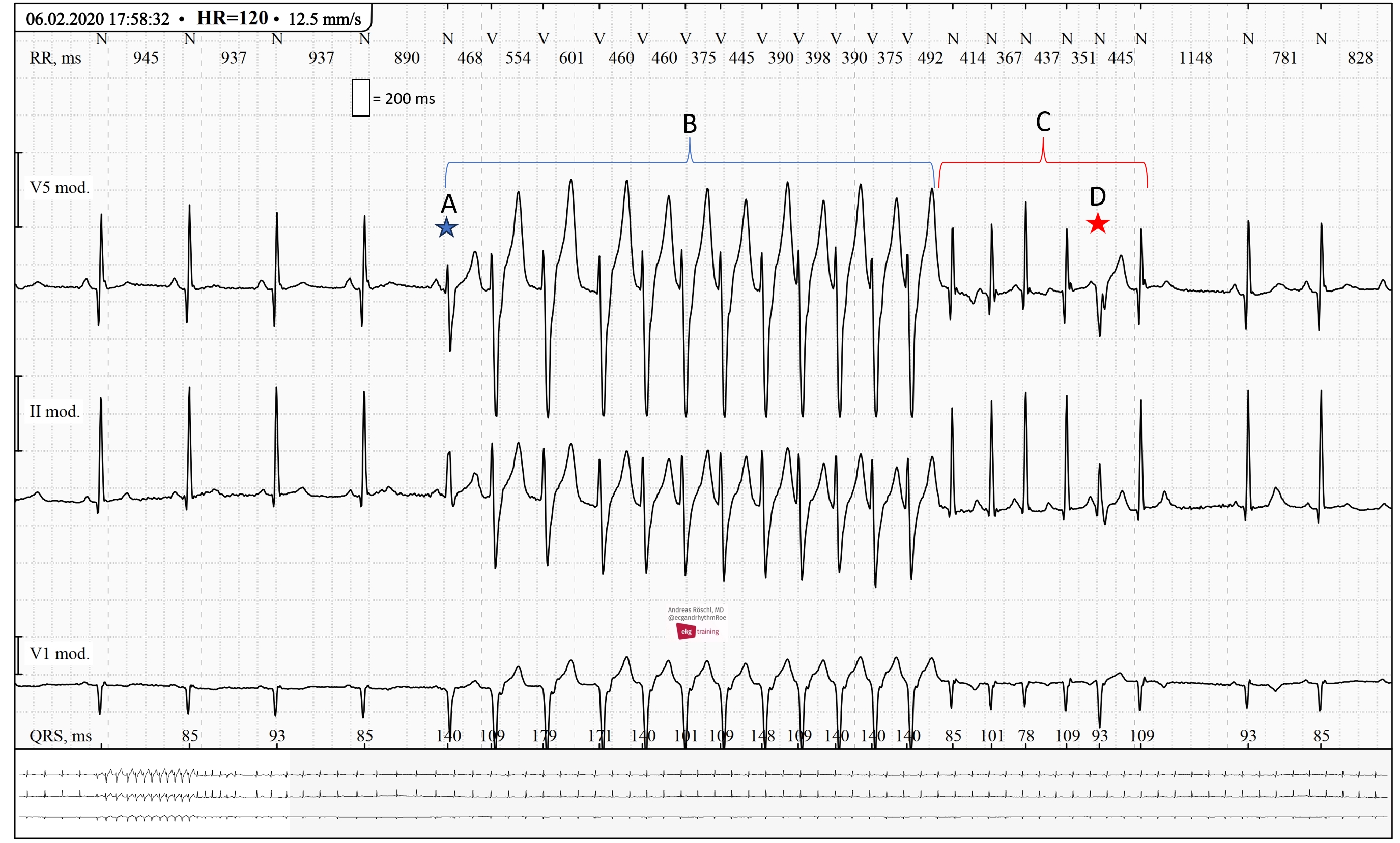 Abnormal Ecg Icd 10 Compare Price Brunofuga adv br