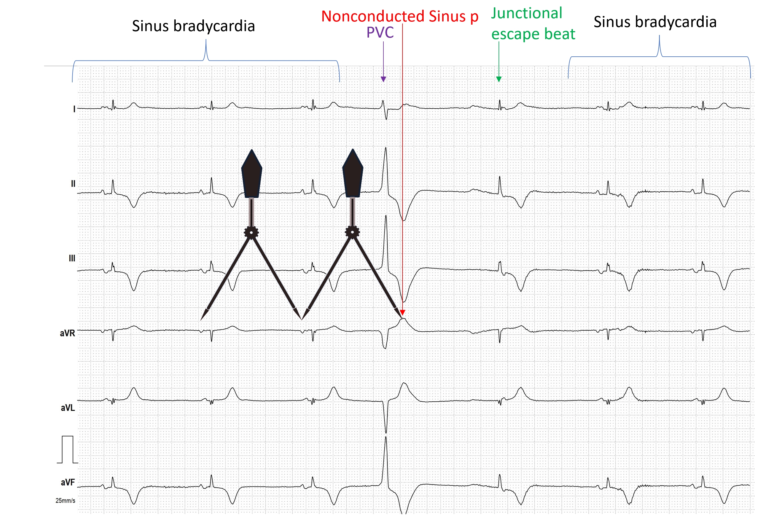 Benign Early Repolarisation • LITFL • ECG Library Diagnosis