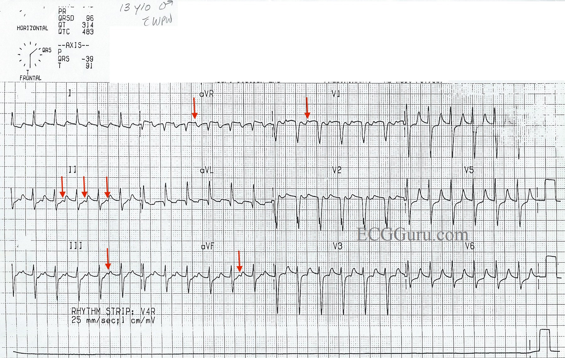 Supraventricular Tachycardia In Pediatric Patient With Wolff Parkinson ...