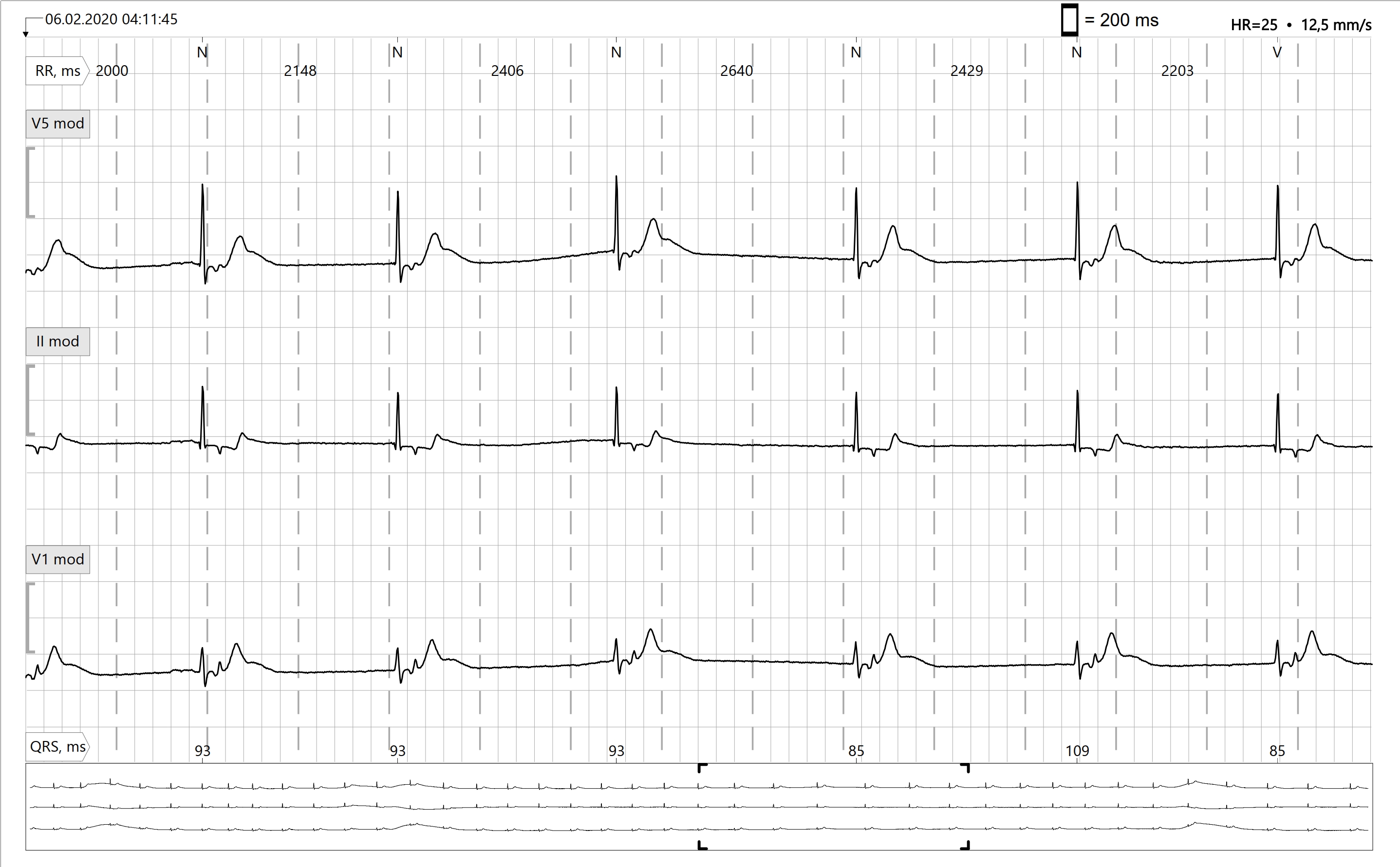 Accelerated junctional rhythm icd 10