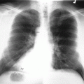 dextrocardia xray