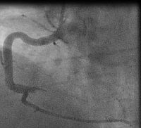 RCA with 100% occlusion