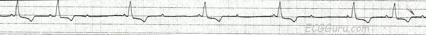 ECG Basics: Second-degree AV Block With Characteristics of Type I and ...