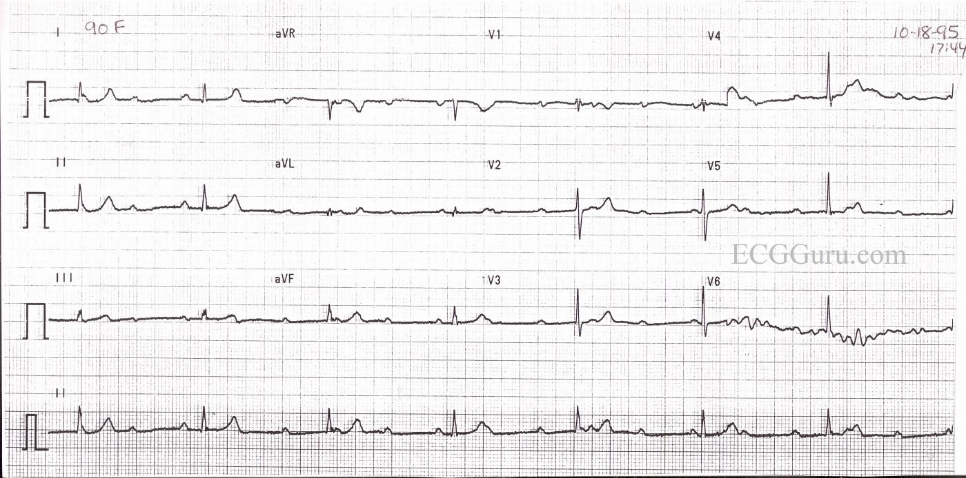 Third-degree AV Block, Complete Heart Block, Junctional Escape Rhythm, 
