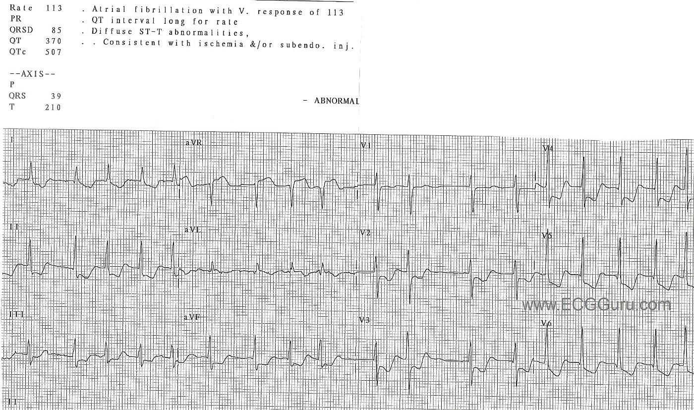 ST Elevation in aVR, Proximal LAD occlusion, ST depression