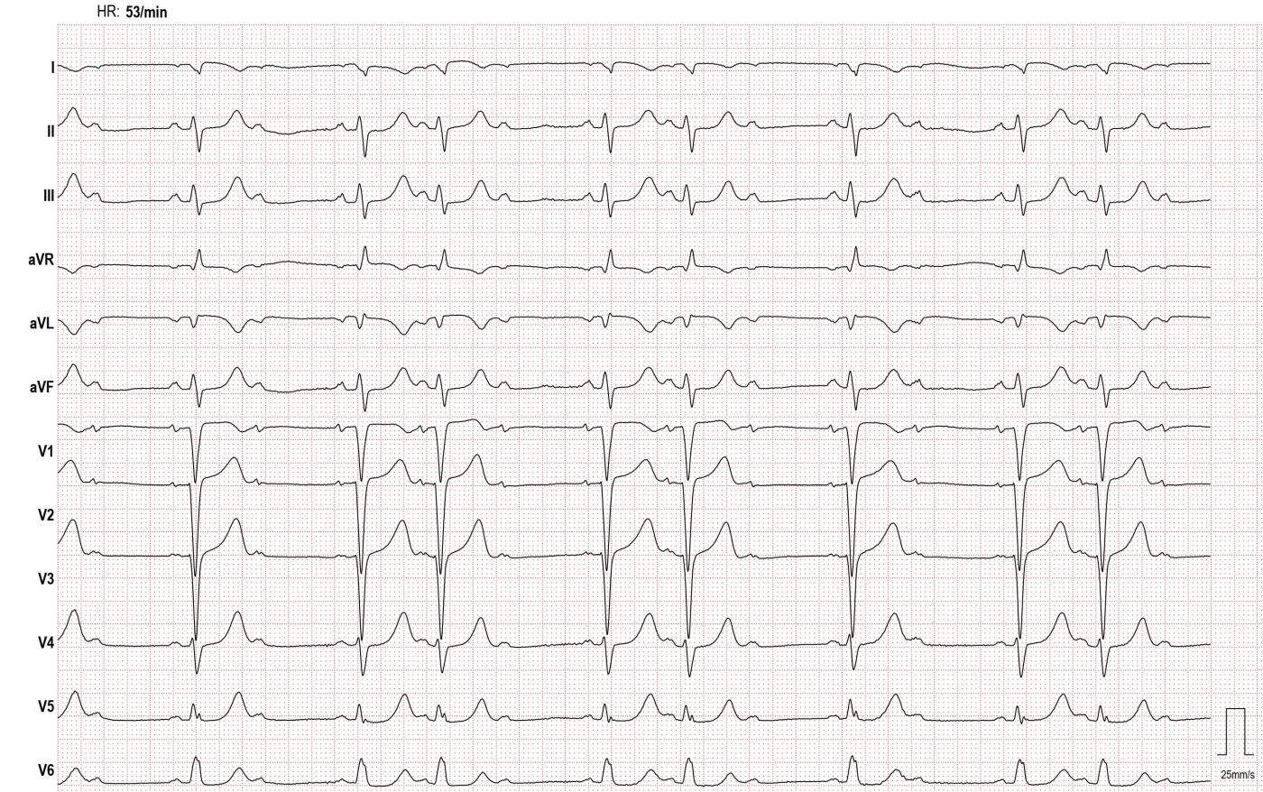 Second Degree Av Block With Left Bundle Branch Block Lead Reversal Second Degree Av Block With Left Bundle Branch Block Lead Reversal