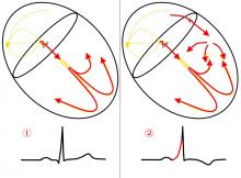 Accessory Pathway Illustration, WPW Illustration, Wolff-Parkinson-White