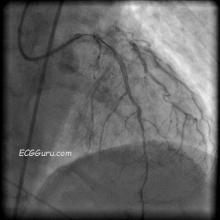 Angiogram, Angioplasty of LAD, Coronary artery disease image