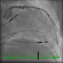 Angiogram of Left Coronary Artery With Pacemaker and Swan Ganz Catheter