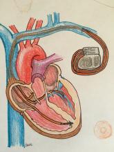 Bi-ventricular pacemaker illustration