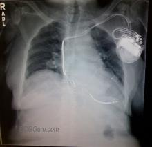 Bi-ventricular pacemaker and ICD xray