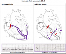 Two Types of Complete Heart Block