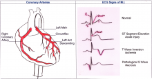 Coronary Arteries, ECG Signs of MI