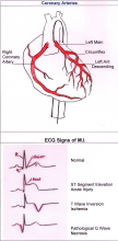 Coronary Arteries and ECG Signs of M.I.