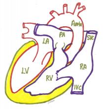 Dextrocardia situs inversus