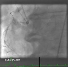 Non-dominant right coronary artery