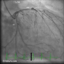 Dominant circumflex artery angiogram