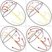 Orthodromic Conduction in SVT Illustration