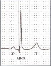 P QRS T, Cardiac Cycle on ECGf Labelled. FREE ILLUSTRATION