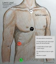 Lewis lead.  Enhancing view of P waves.