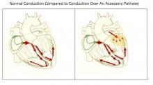 Normal Conduction Compared To Conduction Over An Accessory Pathway