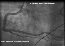 RCA after angioplasty, Right coronary artery after angioplasty, Image right coronary artery after angioplasty, Illustration, Angiogram