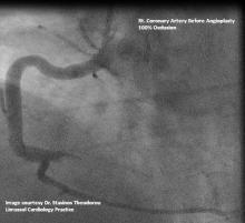 RCA occlusion, Complete occlusion of right coronary artery, Image of complete occlusion of right coronary artery, RCA, Illustration