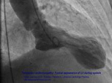 Takotsubo cardiomyopathy, Takotsubo cardiomyopathy typical appearance of left ventricle, Left ventricle in Takotsubo cardiomyopathy, Broken heart syndrome, Image Takotsubo cardiomyopathy