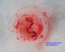 Clot removed from coronary artery photo