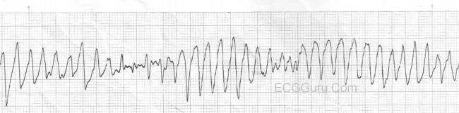 Torsades de Pointes | ECG Guru - Instructor Resources Torsades de Pointes | ECG Guru - Instructor Resources
