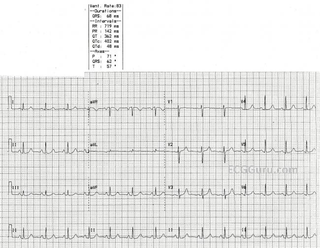 12 lead ecg practice strips