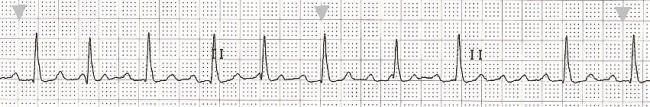ECG Basics: Atrial Flutter With Variable Conduction | ECG Guru ...