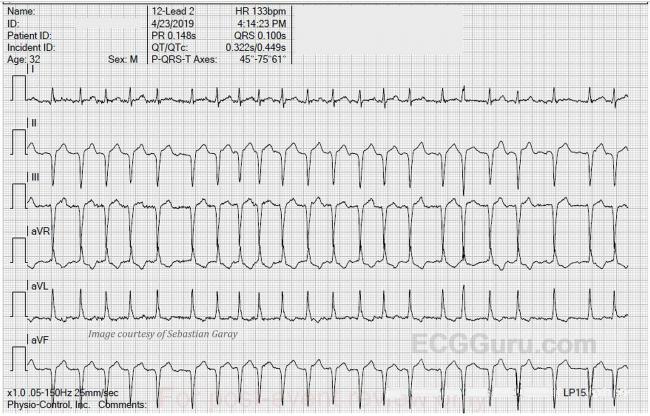 A fib rhythm strip